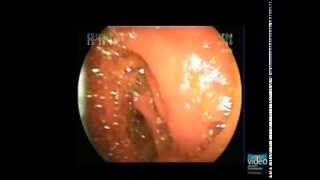 ERCP with BalloonAssisted Enteroscope in Patients with Surgically Altered Upper GI Anatomy [upl. by Kantos692]