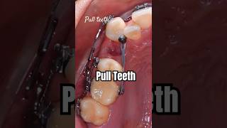 How to pull teeth when braces braces orthodontist dentist dental [upl. by Medina]