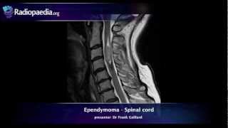 Spinal ependymoma  radiology video tutorial MRI [upl. by Connor]