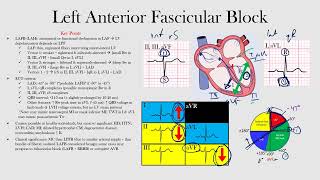 Left Anterior Fascicular Block [upl. by Karyn]