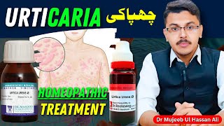 Urtica Urens Homeopathic Medicine Uses  Urticaria  Homeopathic Treatment [upl. by Kuhlman]