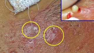 Extraction et drainage abscès de lacné kystique sur le visage Cystic Ance  Partie 1 [upl. by Uhayile518]