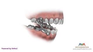 Orthodontics Treatment for Overjet Overbite  Herbst Appliance [upl. by Eyoj]