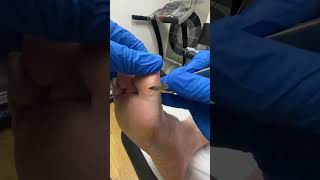 Effective Removal of Very Thick Big Toe Callus by Australian Podiatrist  Expert Techniques [upl. by Neelhtakyram]