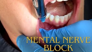 Mental Nerve Block شرح  Local Anaesthesia for Mental Nerve [upl. by Nels739]