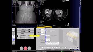 TOMOGRAFÍA MULTIDETECTOR DINÁMICO O TRIFASICO HEPATICO [upl. by Aham]