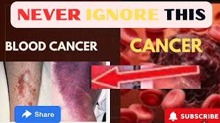 10 blood cancer symptoms and its early warning signs [upl. by Ahsemal]