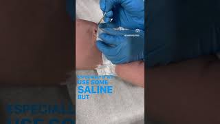 Cauterizing an umbilical cord with silver nitrate in the pediatric office [upl. by Nahtonoj]