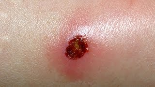 What is MRSA Infection and its Natural Treatment [upl. by Gilroy]