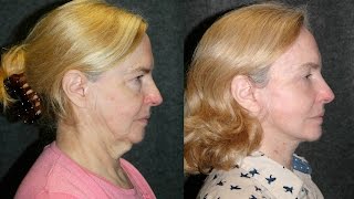 New Facelift Procedure S Lift  Deep Plane Facelift Before and After 65 YO Woman bestnycfacelift [upl. by Asinet]