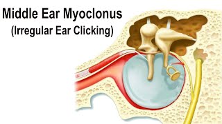 Middle Ear Myoclonus  Irregular Clicking Sound in the Ear [upl. by Attenaz927]