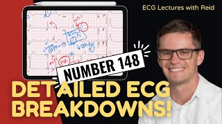 EKG Test Yourself  ECG Case Study 148 [upl. by Doubler]