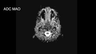 CASE 221 MRI metachromatic leukodystrophy [upl. by Tak30]