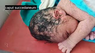 caput succedaneum  swelling of the scalp in newborn [upl. by Leshia]