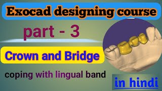 How to design lingual band in exocad  exocad crown design in hindi With Lingual Band [upl. by Gehlbach]