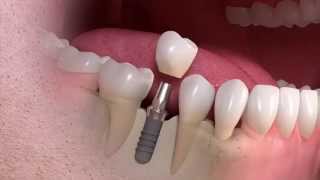 Straumann  Implantborne singletooth treatment [upl. by Higginson79]