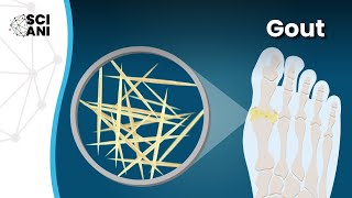 Acute Gout Attack  How To Manage Acute Gout  What Foods To Avoid In Chronic Gout  dr afzal [upl. by Salomo]