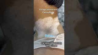 VITILIGO PERMANENT COSMETIC TATTOOING  VITILIGO TREATMENT  vitiligoindia whitespottreatment [upl. by Leval]