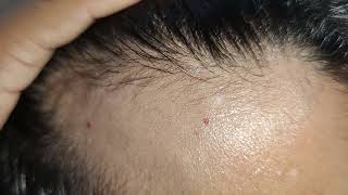 hair regrowth after treatment varanasi banaras treatment [upl. by Aisat]