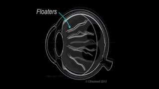 Vitreous 1 Vitreous Aging and Floaters [upl. by Itram]