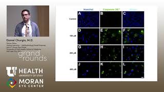 Proliferative Vitreoretinopathy [upl. by Aivatal]