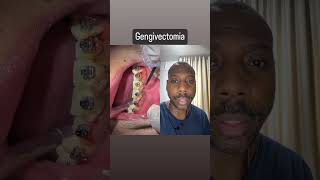 Gengivectomia dentes gengiva dentista [upl. by Sobel139]