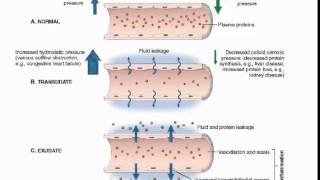 Exudate vs transudate [upl. by Nnahgem536]