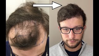 6 Months Hair Transplant results  UK [upl. by Marquez]