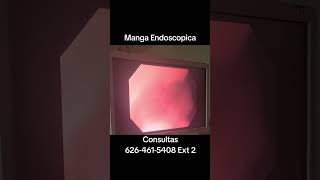 Manga Endoscopica por el Dr Don Portocarrero en Los Angeles CA [upl. by Kristien196]