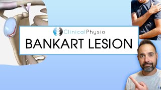 Bankart lesion  Expert Physio Reviews Shoulder Dislocations Mechanism Of Injury and Treatment [upl. by Boatwright]