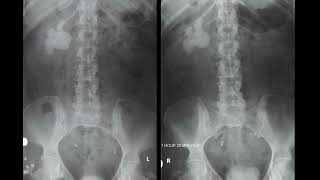 26 Ulcerative colitis UC with mucosal thickening [upl. by Aushoj254]