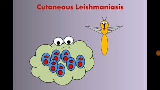 Cutaneous Leishmaniasis الليشمانيا الجلدية [upl. by Anelim]