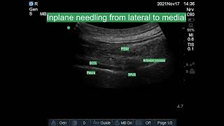 Ultrasound guided Thoracic Paravertebral Block [upl. by Charlot5]