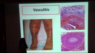 Calciphylaxis Dr Mona Tawfik MNDU 2016 [upl. by Dlanor]