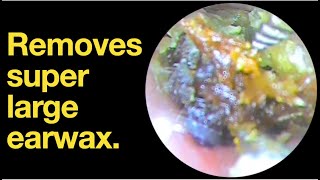 Removes super large earwax ear wax removal  ear cleaning  ASMR  relaxation  relax [upl. by Ssitnerp]