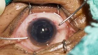 Phaco Direct Chop Phacoemulsification cataract surgery in 7 minutes [upl. by Ewnihc]