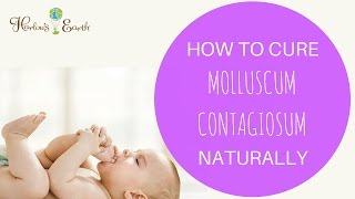 How To Cure Molluscum Contagiosum Naturally [upl. by Cristine814]