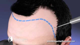 NeoGraft Michigan Hair Restoration [upl. by Waldman]