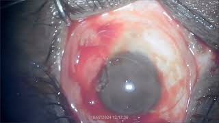 Pterygium excision with autograft By Dr K L Agrawal [upl. by Edasalof948]