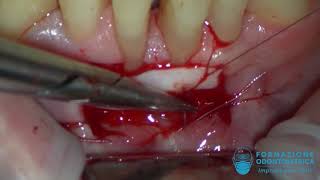 Innesto gengivale libero  free gingival graft [upl. by Gokey]