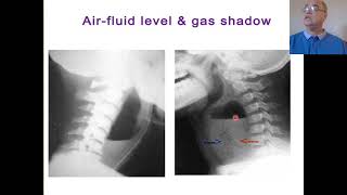 Retropharyngeal abscess Prevertebral abscess Acute n chronic retropharyngeal abscess [upl. by Tunnell]