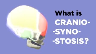 What is Craniosynostosis [upl. by Egap]