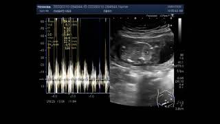 Anencephaly with a pregnancy of about 16 weeks [upl. by Analem]