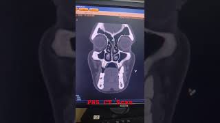 X ray of jaw viral shortsviral videodentaltreatment dentist maxillofacial surgery [upl. by Leanna]