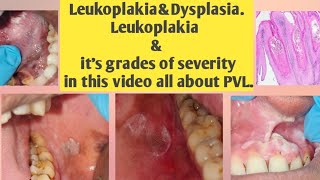 Leukoplakia and DysplasiaLeukoplakia amp its grades of severitythis video all type Leukoplakiaamp PVL [upl. by Athalee]