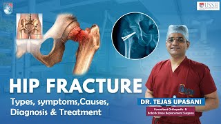 Hip Fracture Hindi  Most Asked Questions about Hip Fracture  Treatment of Hip Fracture [upl. by Nuris]