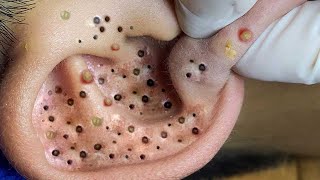 Big Cystic Acne Blackheads Extraction Blackheads amp Milia Whiteheads Removal Pimple Popping  4479 [upl. by Ahsuoj]