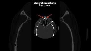 Bilateral nasal bone fractures shoets [upl. by Annasiul]