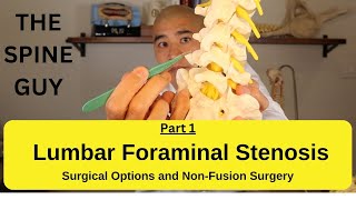 Lumbar Foraminal Stenosis  Surgical Options and NonFusion Surgery [upl. by Acyssej]