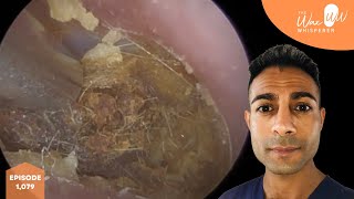 1079  Crusted Ear Wax Removal off Eardrum [upl. by Nnyltiak]